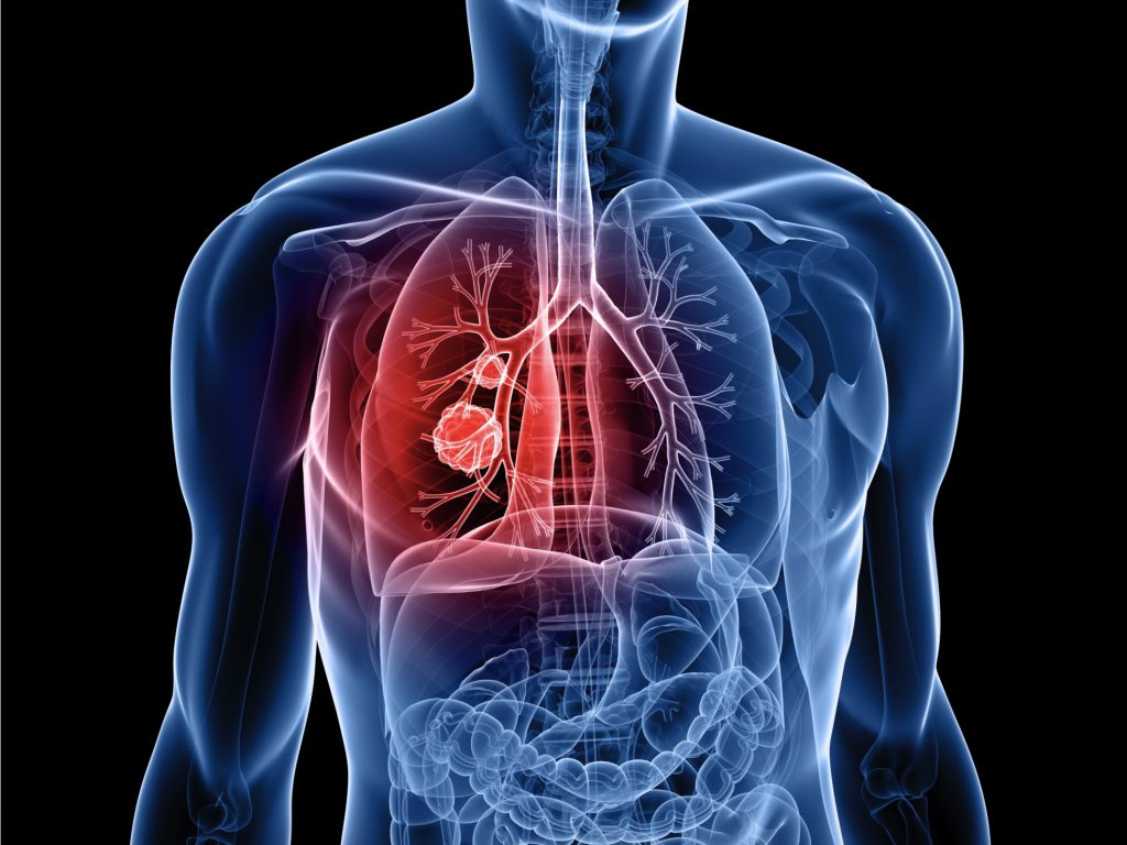 lung-cancer-odisha