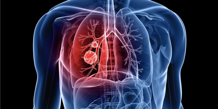 lung-cancer-odisha