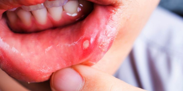 mouth-ulcer