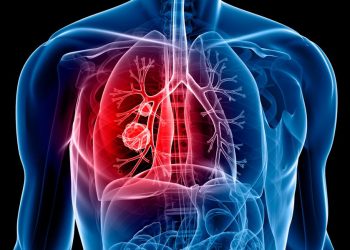 lung cancer AI