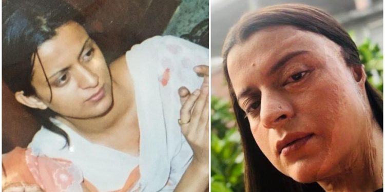 Kangana's sister Rangoli shares horrific details of acid attack