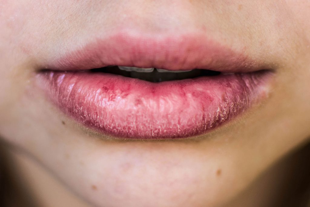 Cheapest remedies for chapped lips in winter season