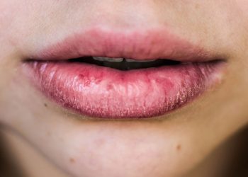 Cheapest remedies for chapped lips in winter season