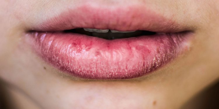 Cheapest remedies for chapped lips in winter season