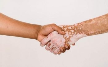 Indian subcontinent highest prevalence of vitiligo in world