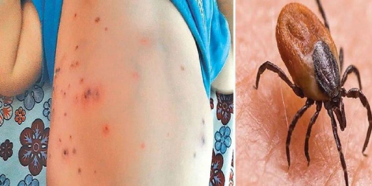 Scrub Typhus in Odisha